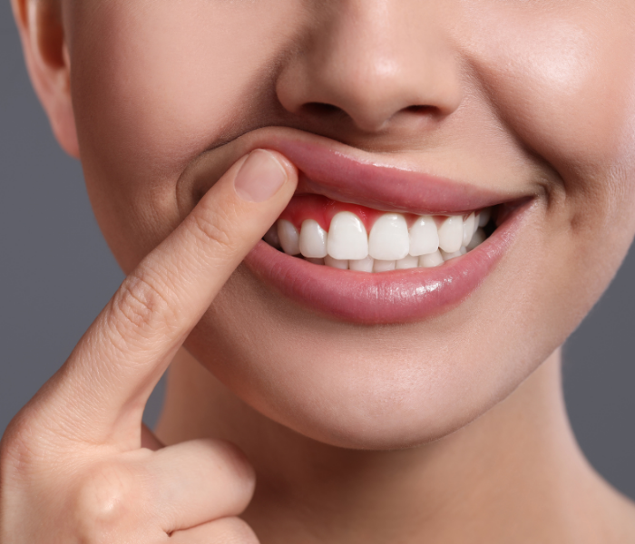 Diş Eti Hastalıkları ve Tedavisi